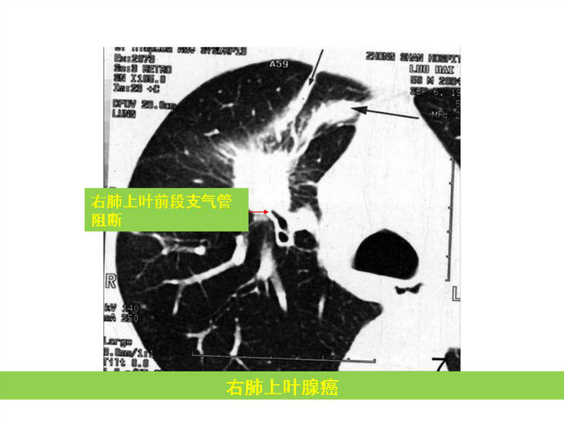 常见影像病例读片汇总