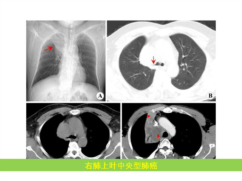 常见影像病例读片汇总