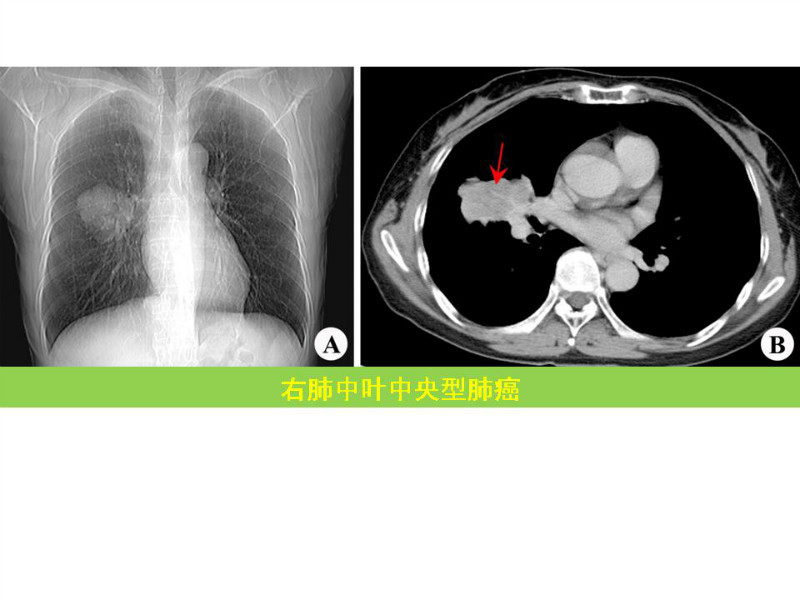 常见影像病例读片汇总