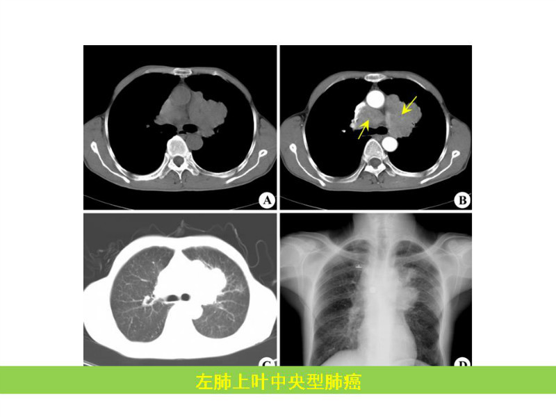 常见影像病例读片汇总