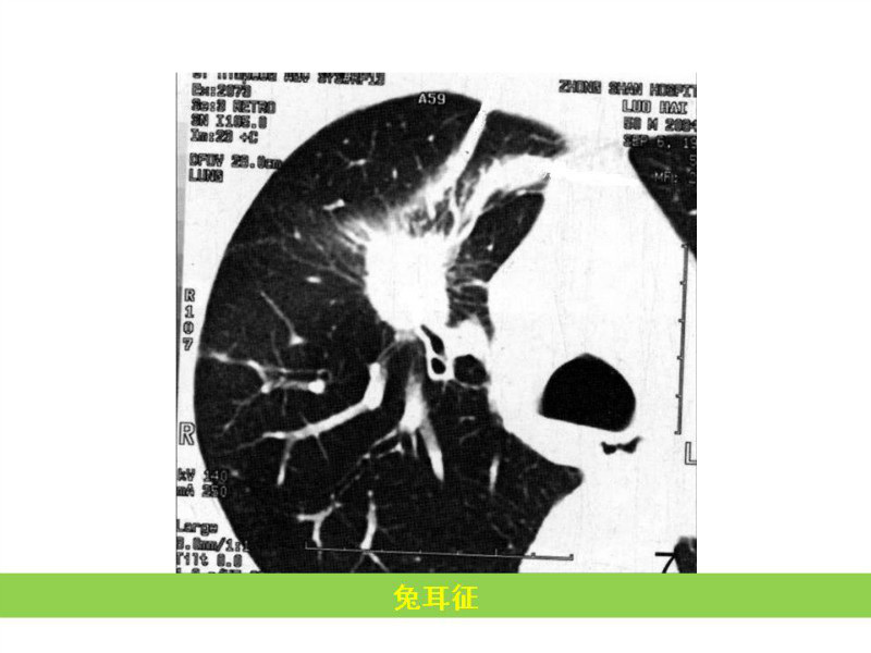 常见影像病例读片汇总