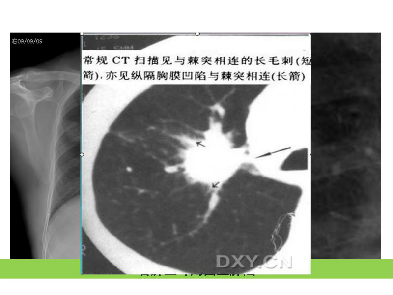 常见影像病例读片汇总