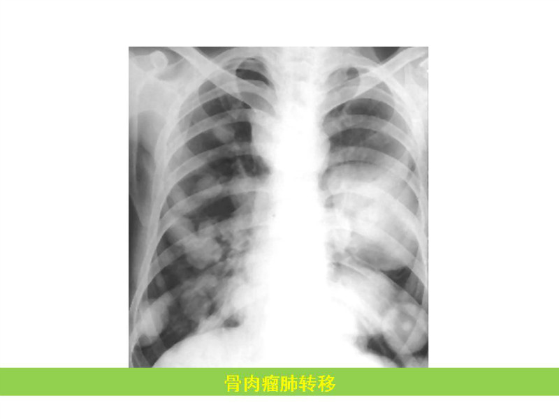 常见影像病例读片汇总