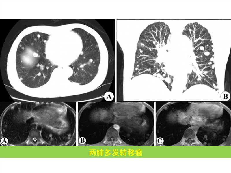 常见影像病例读片汇总