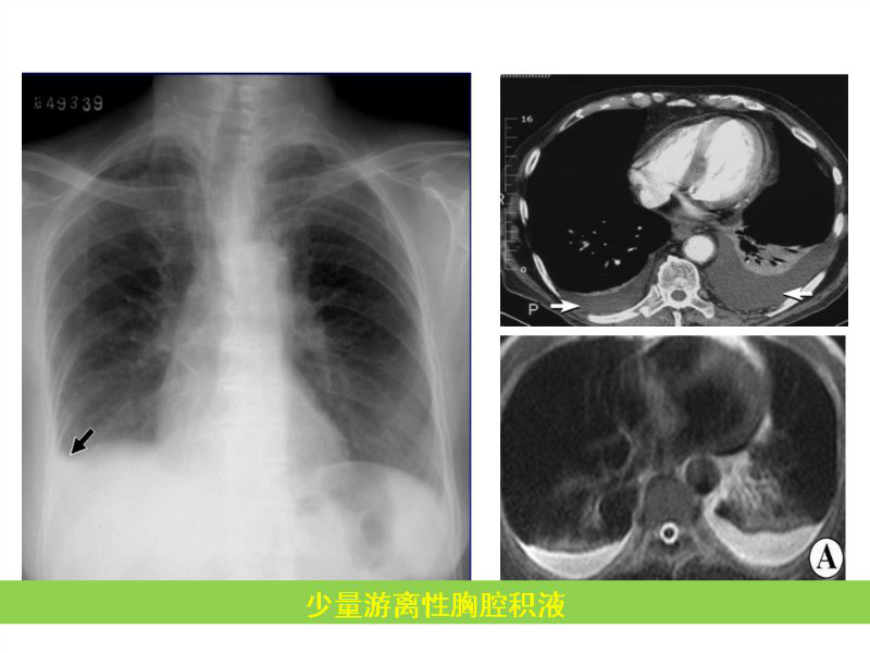 常见影像病例读片汇总
