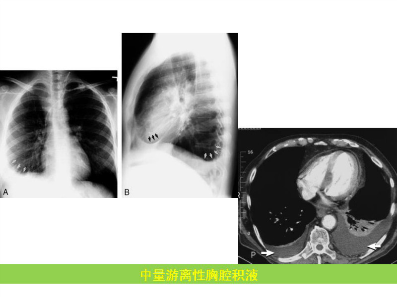 常见影像病例读片汇总