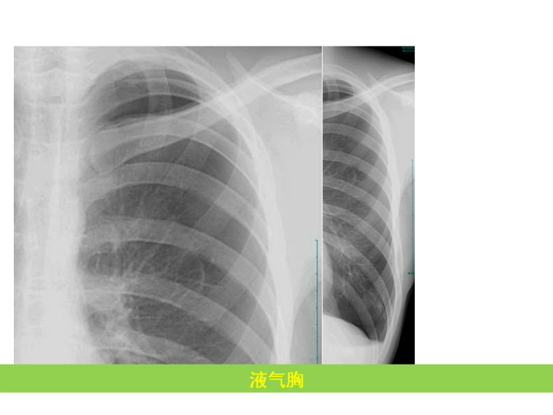 常见影像病例读片汇总