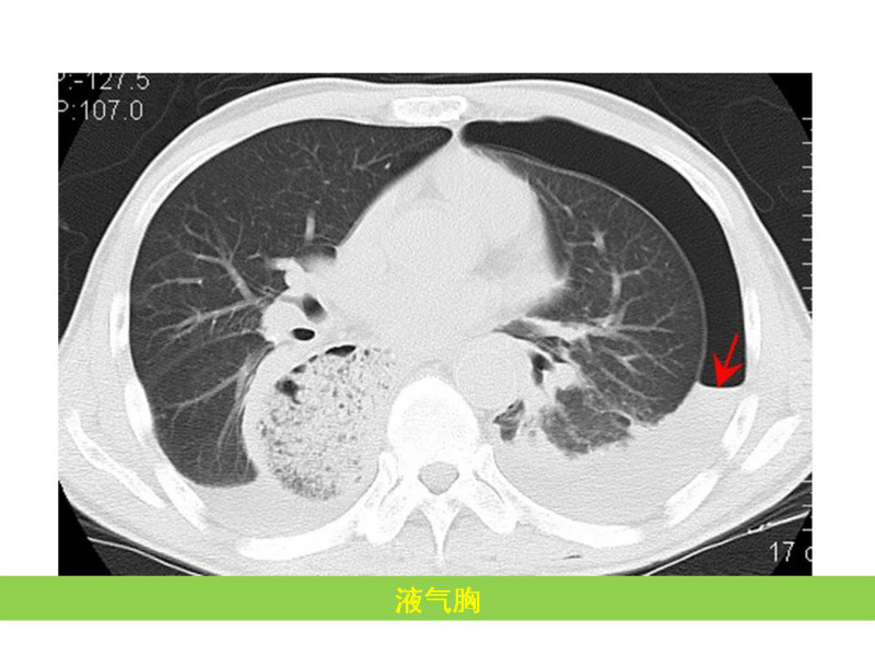 常见影像病例读片汇总