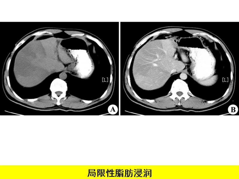 常见影像病例读片汇总