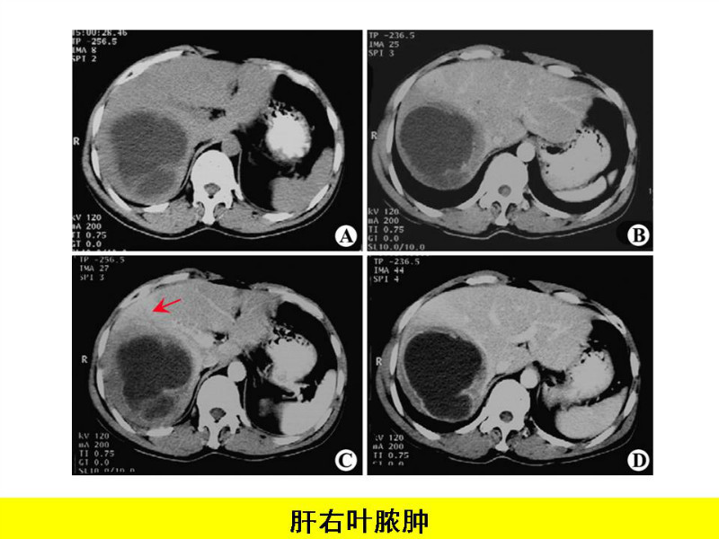 常见影像病例读片汇总