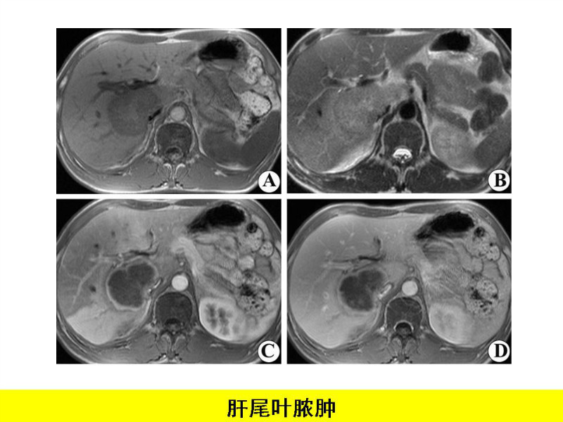 常见影像病例读片汇总