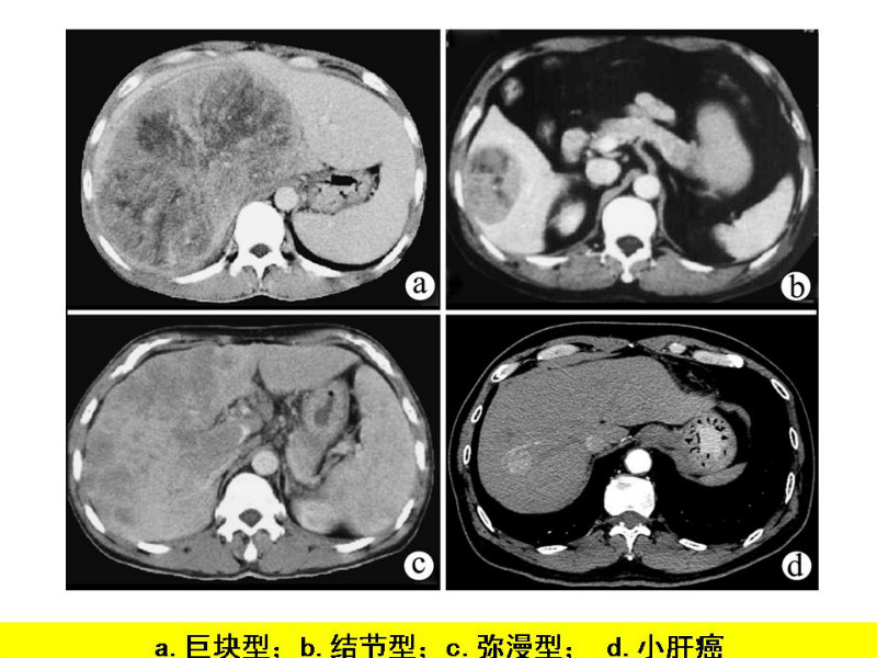 常见影像病例读片汇总