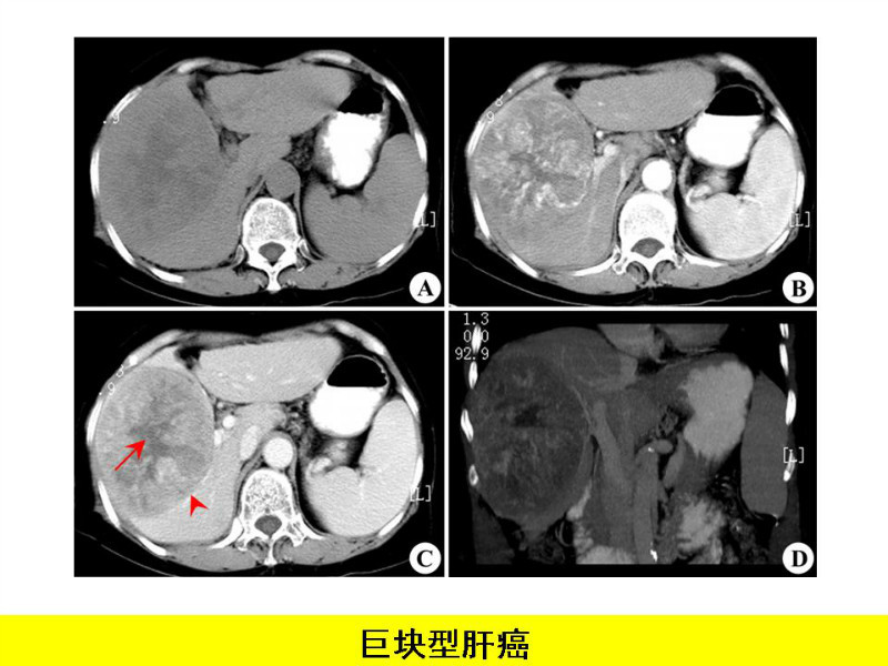 常见影像病例读片汇总