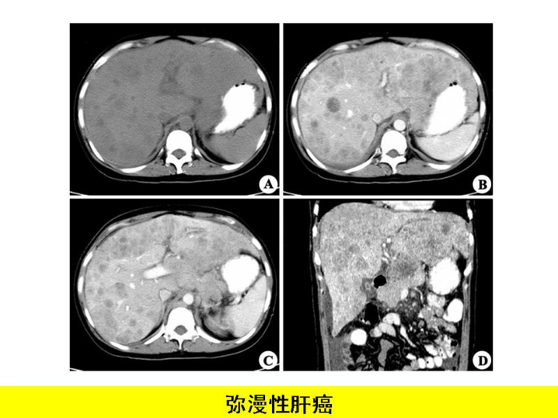 常见影像病例读片汇总