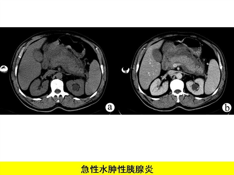 常见影像病例读片汇总