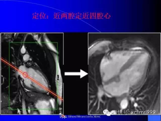 【PPT】心脏MRI及直肠高分辨技术