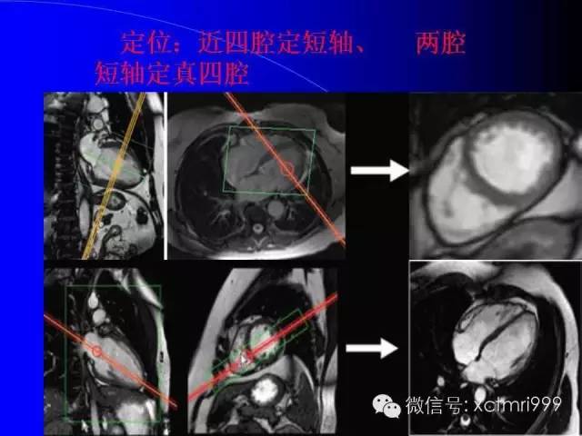 【PPT】心脏MRI及直肠高分辨技术