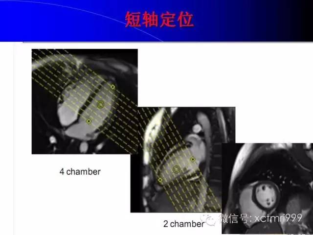 【PPT】心脏MRI及直肠高分辨技术