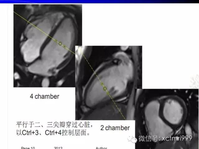 【PPT】心脏MRI及直肠高分辨技术