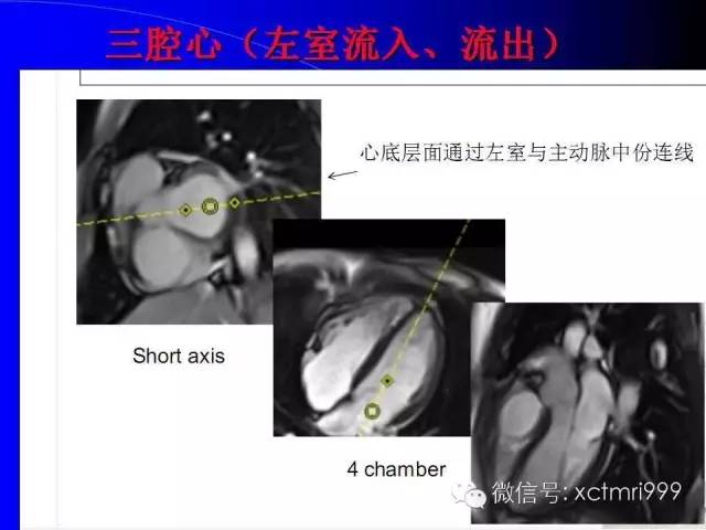 【PPT】心脏MRI及直肠高分辨技术
