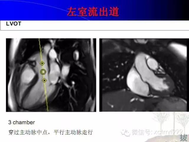 【PPT】心脏MRI及直肠高分辨技术