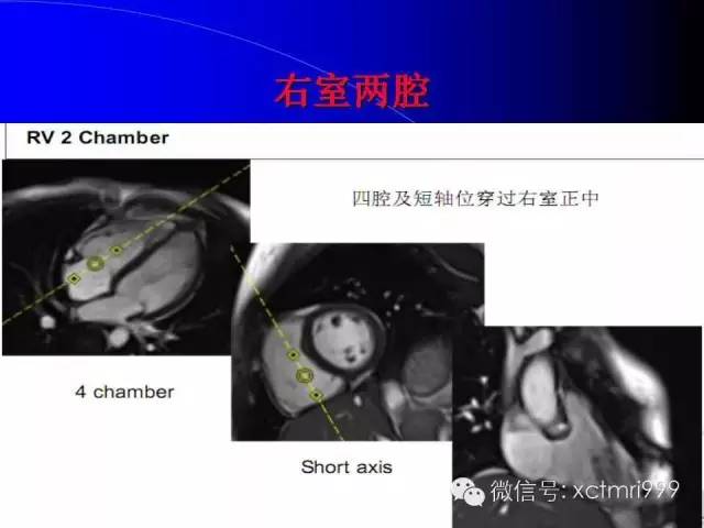 【PPT】心脏MRI及直肠高分辨技术