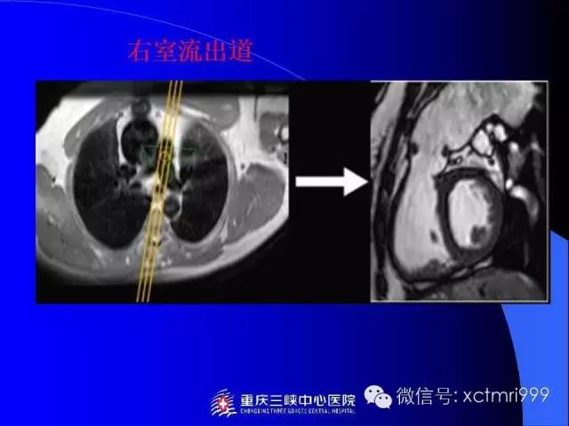 【PPT】心脏MRI及直肠高分辨技术