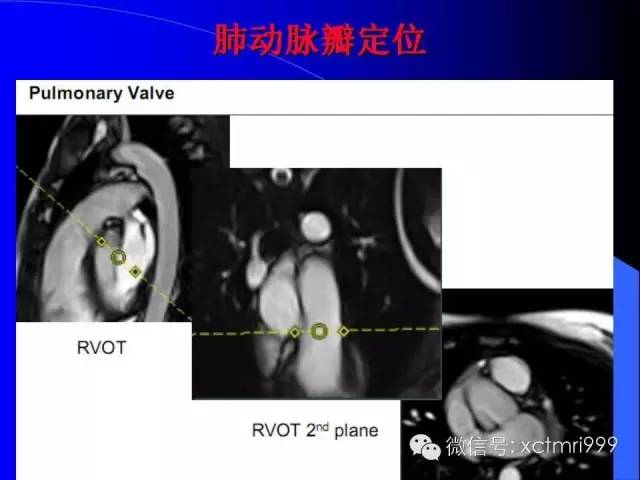【PPT】心脏MRI及直肠高分辨技术