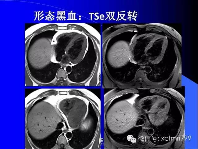 【PPT】心脏MRI及直肠高分辨技术