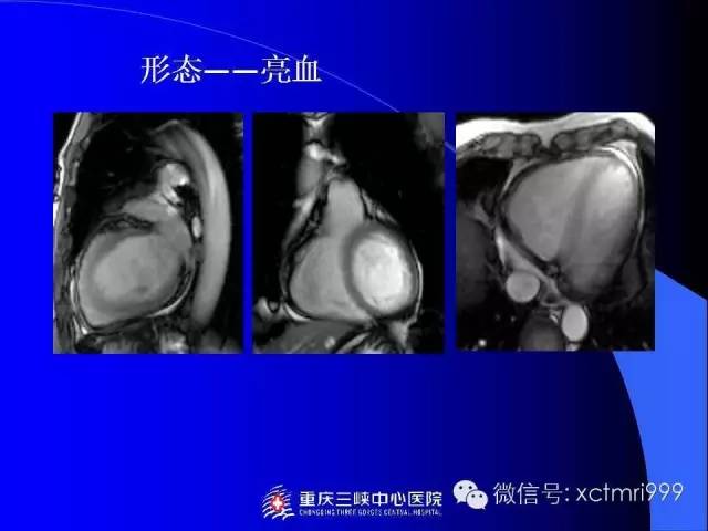【PPT】心脏MRI及直肠高分辨技术