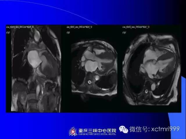 【PPT】心脏MRI及直肠高分辨技术