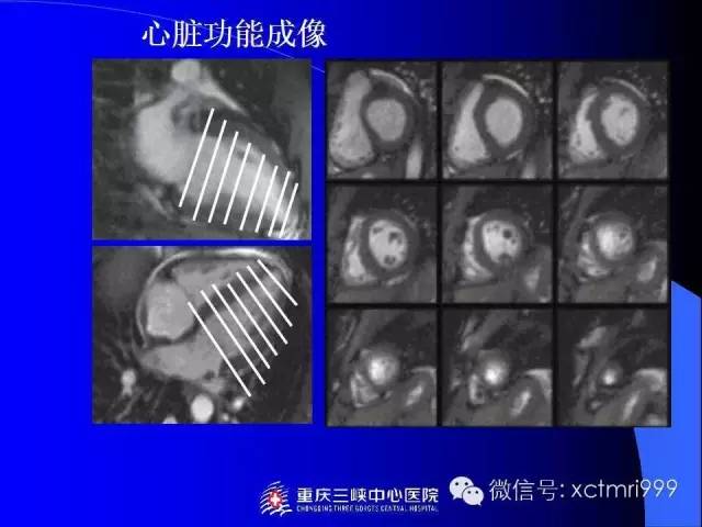 【PPT】心脏MRI及直肠高分辨技术