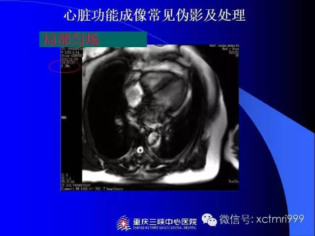 【PPT】心脏MRI及直肠高分辨技术