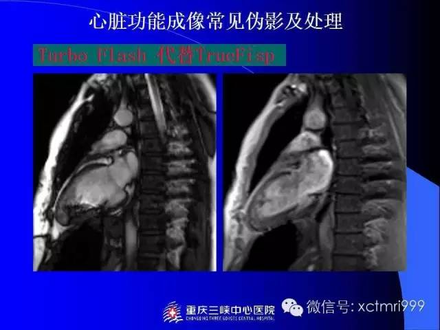 【PPT】心脏MRI及直肠高分辨技术