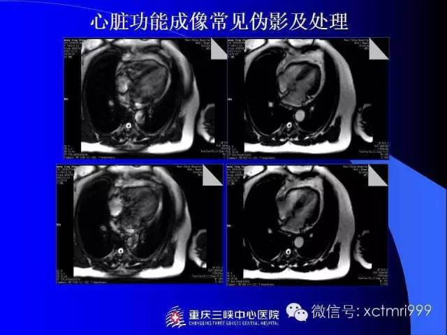 【PPT】心脏MRI及直肠高分辨技术
