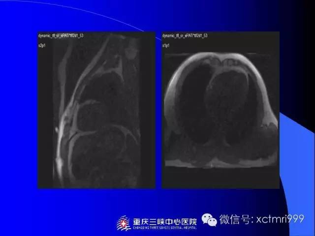 【PPT】心脏MRI及直肠高分辨技术