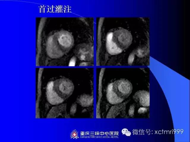 【PPT】心脏MRI及直肠高分辨技术