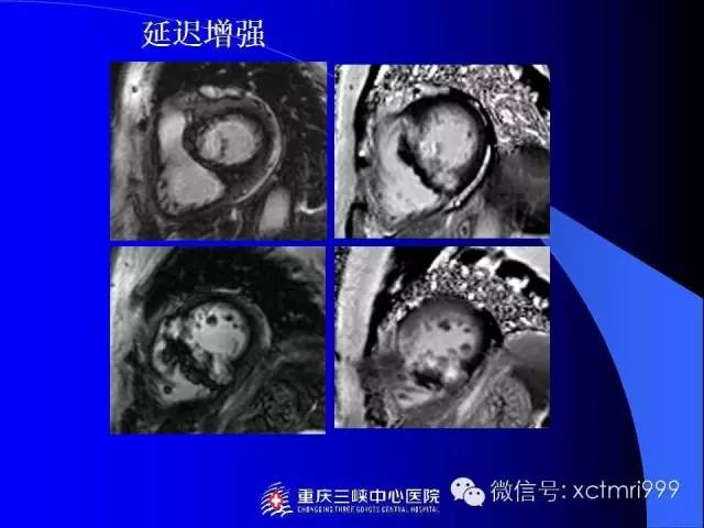 【PPT】心脏MRI及直肠高分辨技术