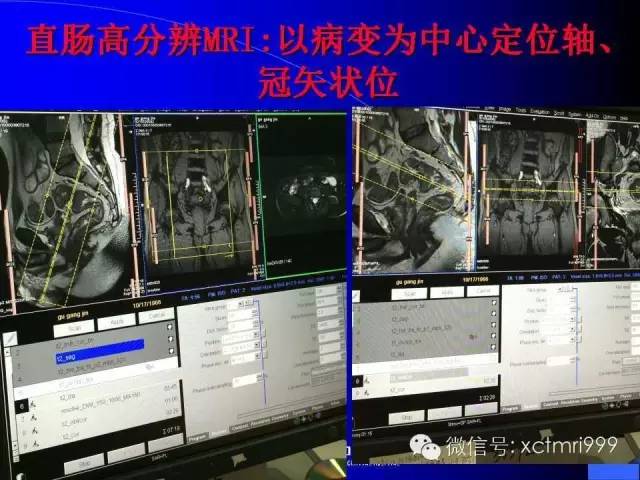 【PPT】心脏MRI及直肠高分辨技术