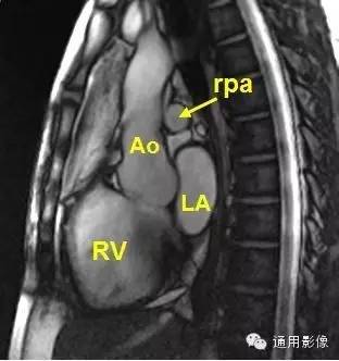 心脏磁共振上的正常解剖结构 心脏磁共振上的正常解剖结构