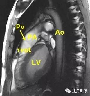 心脏磁共振上的正常解剖结构 心脏磁共振上的正常解剖结构