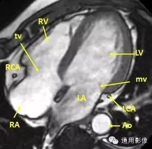 心脏磁共振上的正常解剖结构 心脏磁共振上的正常解剖结构