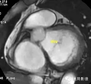 心脏磁共振上的正常解剖结构 心脏磁共振上的正常解剖结构