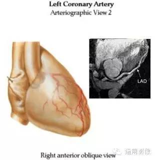 心脏磁共振上的正常解剖结构 心脏磁共振上的正常解剖结构