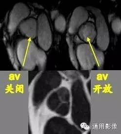 心脏磁共振上的正常解剖结构 心脏磁共振上的正常解剖结构