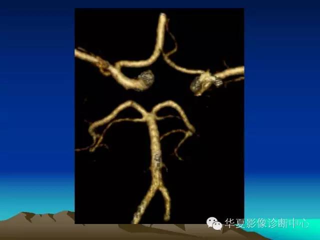 【PPT】脑血管解剖