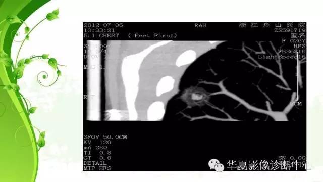 【PPT】早期肺腺癌中塌陷的病理影像分析