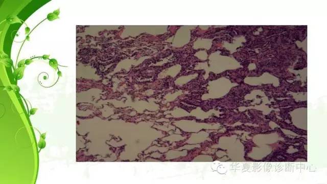 【PPT】早期肺腺癌中塌陷的病理影像分析