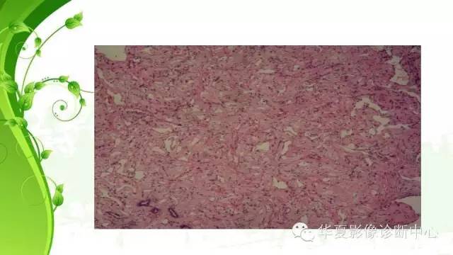 【PPT】早期肺腺癌中塌陷的病理影像分析