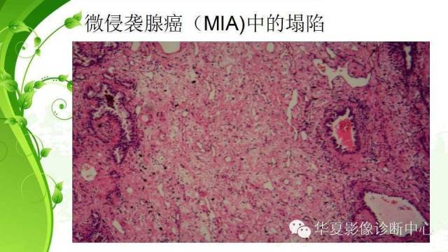 【PPT】早期肺腺癌中塌陷的病理影像分析
